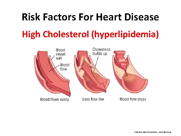 Risk Factors For Heart Disease High Cholesterol (hyperlipidemia) American Heart Association. www. heart. org