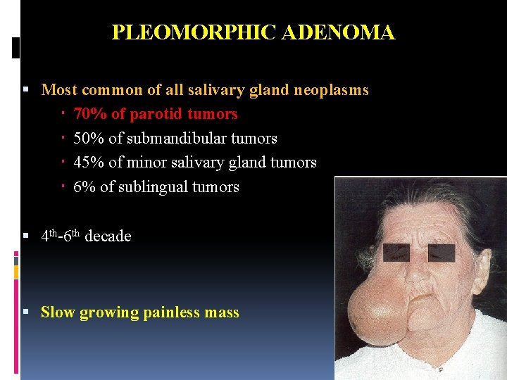 PLEOMORPHIC ADENOMA Most common of all salivary gland neoplasms 70% of parotid tumors 50%