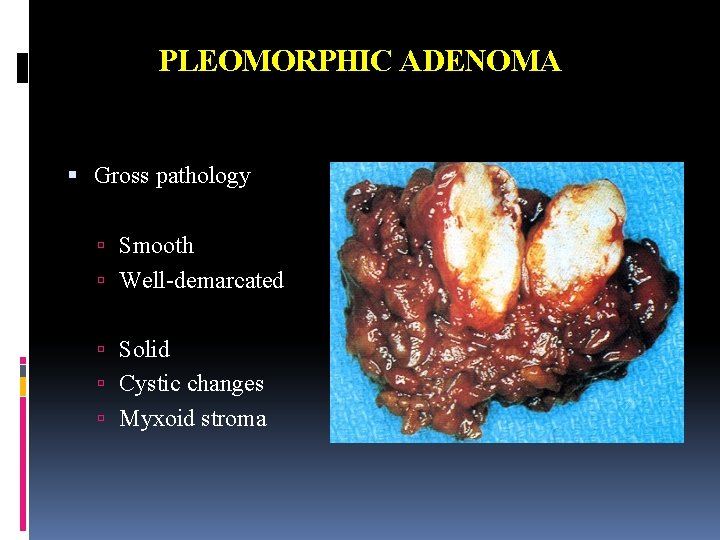 PLEOMORPHIC ADENOMA Gross pathology Smooth Well-demarcated Solid Cystic changes Myxoid stroma 