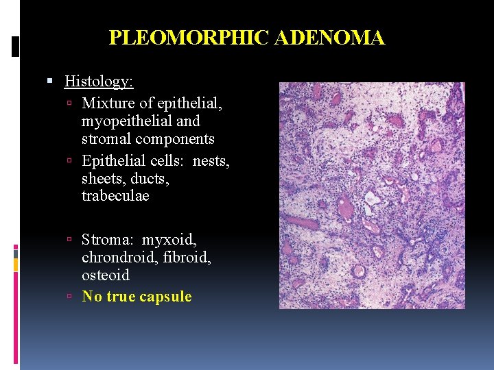 PLEOMORPHIC ADENOMA Histology: Mixture of epithelial, myopeithelial and stromal components Epithelial cells: nests, sheets,