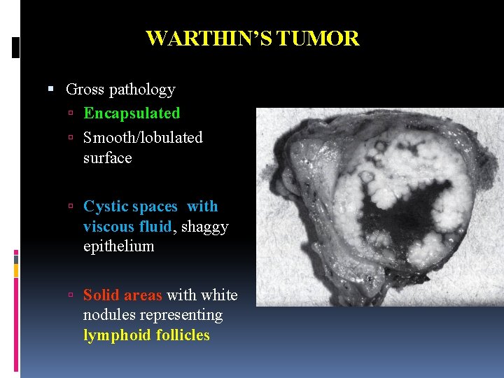 WARTHIN’S TUMOR Gross pathology Encapsulated Smooth/lobulated surface Cystic spaces with viscous fluid, shaggy epithelium WARTHIN’S TUMOR Gross pathology Encapsulated Smooth/lobulated surface Cystic spaces with viscous fluid, shaggy epithelium