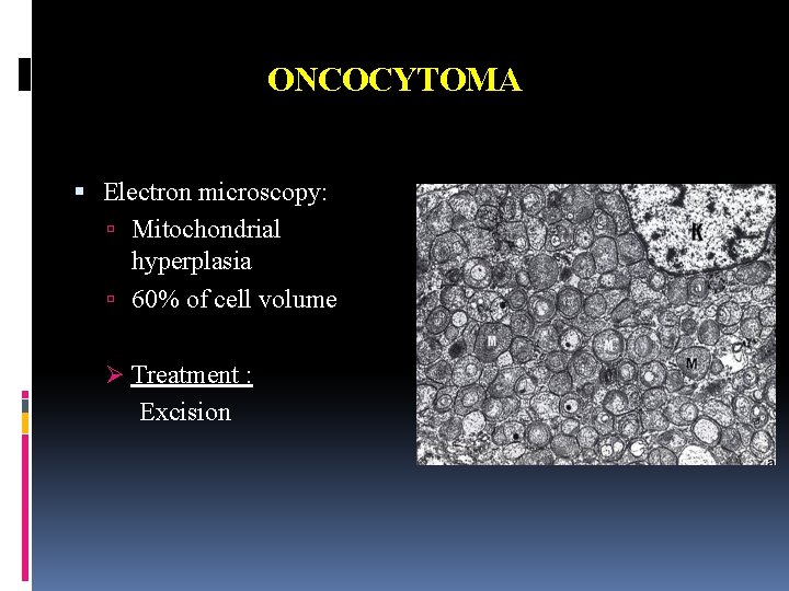 ONCOCYTOMA Electron microscopy: Mitochondrial hyperplasia 60% of cell volume Ø Treatment : Excision 