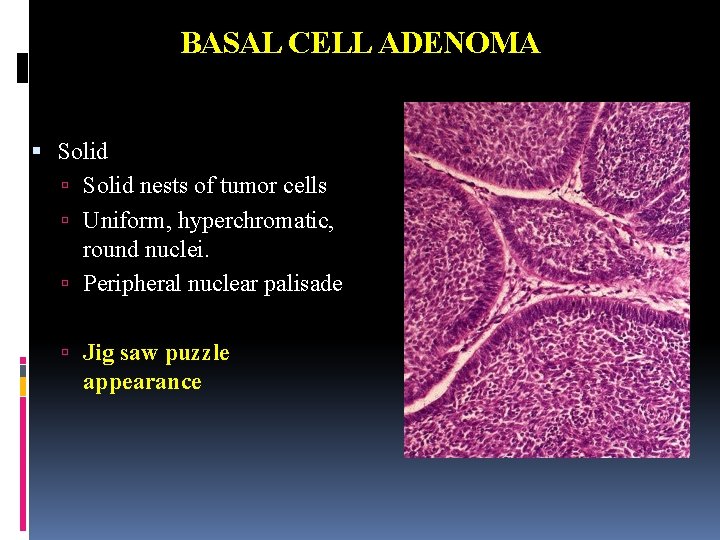 BASAL CELL ADENOMA Solid nests of tumor cells Uniform, hyperchromatic, round nuclei. Peripheral nuclear