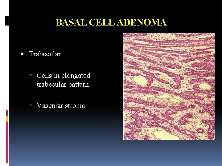 BASAL CELL ADENOMA Trabecular Cells in elongated trabecular pattern Vascular stroma 