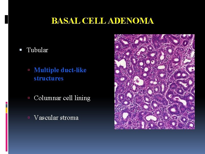 BASAL CELL ADENOMA Tubular Multiple duct-like structures Columnar cell lining Vascular stroma 