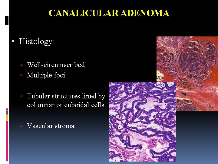 CANALICULAR ADENOMA Histology: Well-circumscribed Multiple foci Tubular structures lined by columnar or cuboidal cells