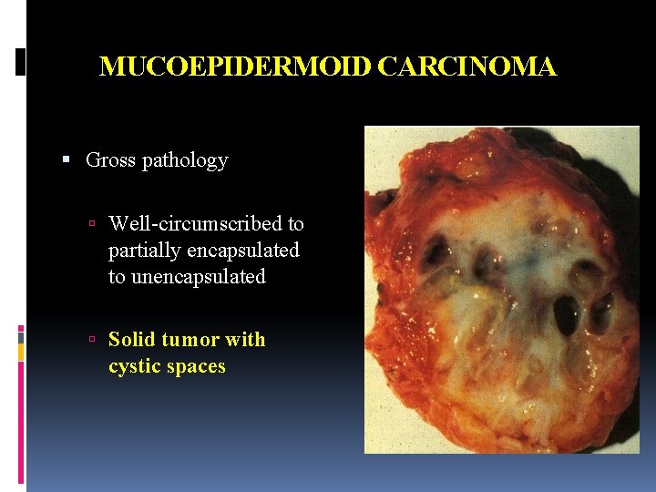 MUCOEPIDERMOID CARCINOMA Gross pathology Well-circumscribed to partially encapsulated to unencapsulated Solid tumor with cystic