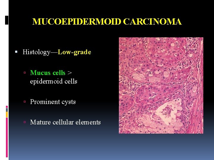 MUCOEPIDERMOID CARCINOMA Histology—Low-grade Mucus cells > epidermoid cells Prominent cysts Mature cellular elements 