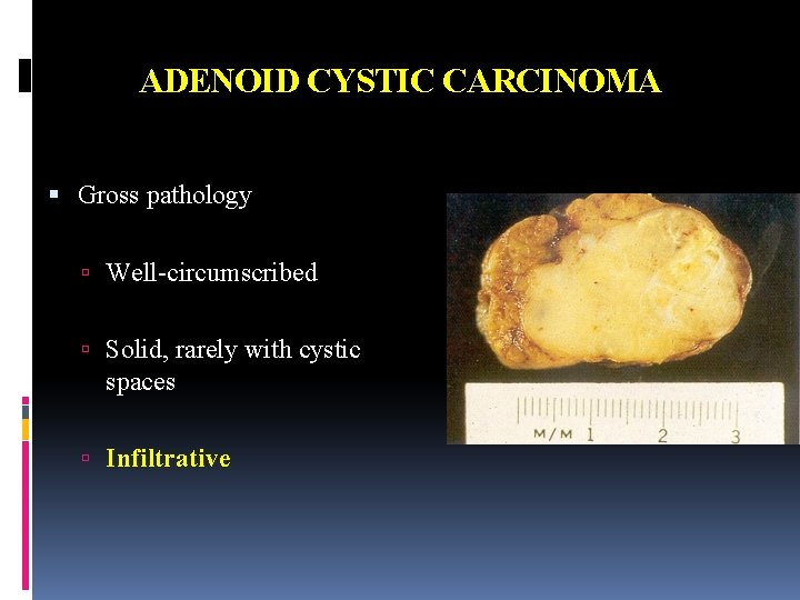 ADENOID CYSTIC CARCINOMA Gross pathology Well-circumscribed Solid, rarely with cystic spaces Infiltrative 