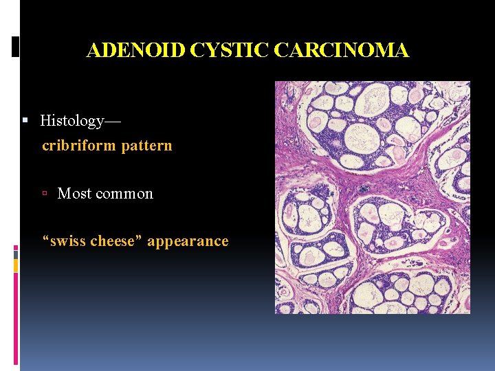 ADENOID CYSTIC CARCINOMA Histology— cribriform pattern Most common “swiss cheese” appearance 