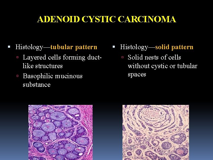 ADENOID CYSTIC CARCINOMA Histology—tubular pattern Layered cells forming ductlike structures Basophilic mucinous substance Histology—solid