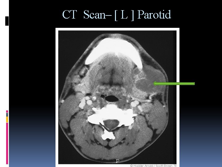 CT Scan– [ L ] Parotid 