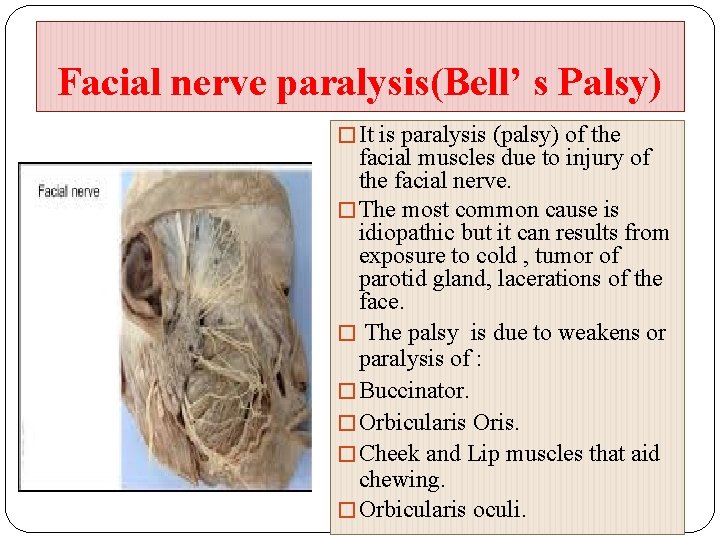 Facial nerve paralysis(Bell’ s Palsy) � It is paralysis (palsy) of the facial muscles