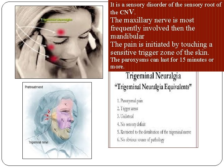 It is a sensory disorder of the sensory root of the CNV. The maxillary