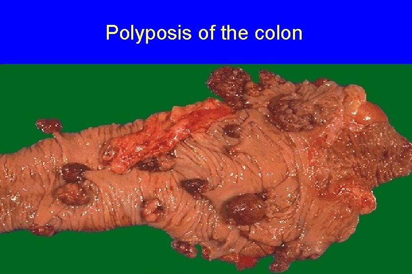 Polyposis of the colon 