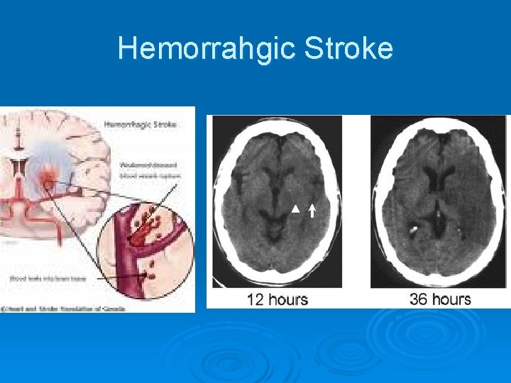 Hemorrahgic Stroke 