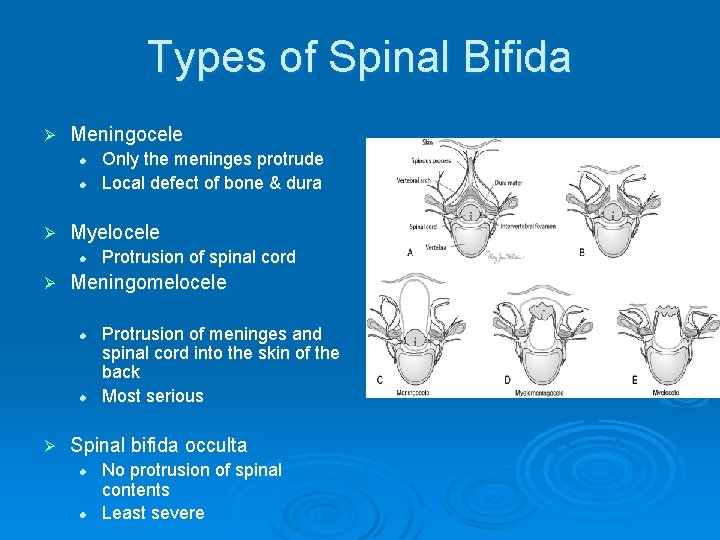 Types of Spinal Bifida Ø Meningocele l l Ø Myelocele l Ø Protrusion of