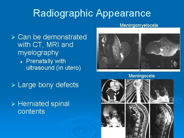 Radiographic Appearance Meningomyelocele Ø Can be demonstrated with CT, MRI and myelography l Prenatally