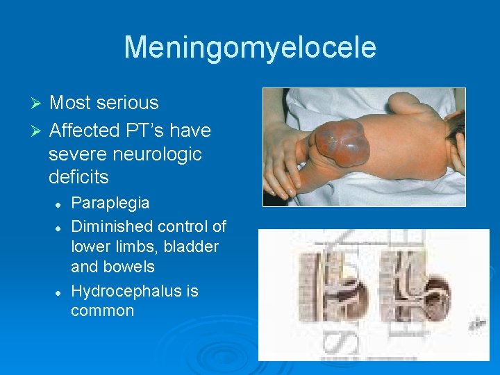 Meningomyelocele Most serious Ø Affected PT’s have severe neurologic deficits Ø l l l