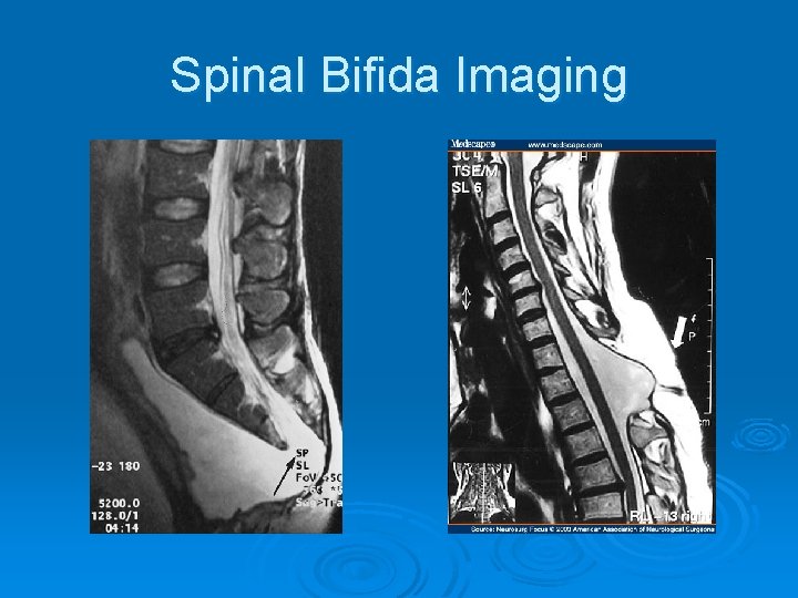 Spinal Bifida Imaging 