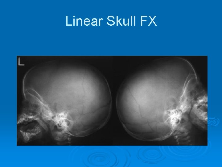 Linear Skull FX 