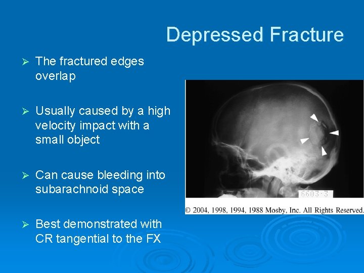 Depressed Fracture Ø The fractured edges overlap Ø Usually caused by a high velocity