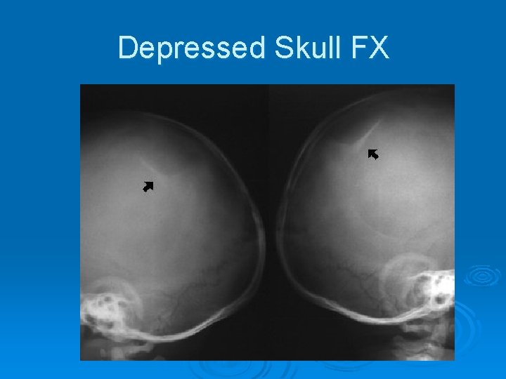 Depressed Skull FX 