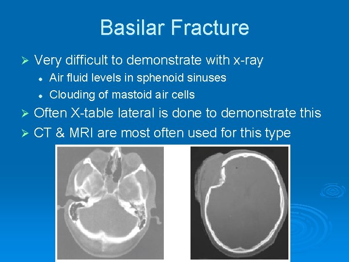 Basilar Fracture Ø Very difficult to demonstrate with x-ray l l Air fluid levels