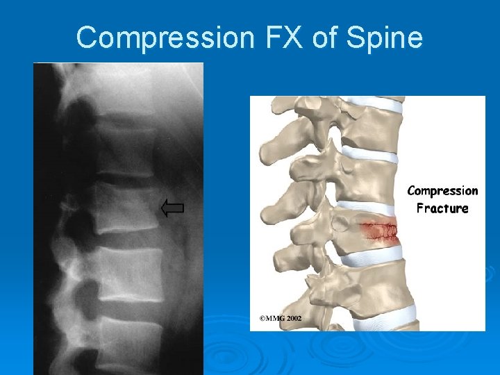 Compression FX of Spine 