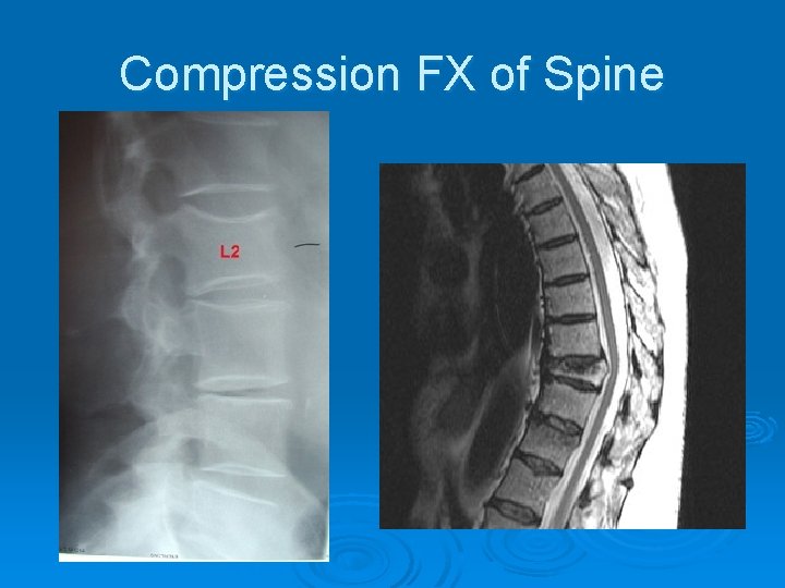 Compression FX of Spine 