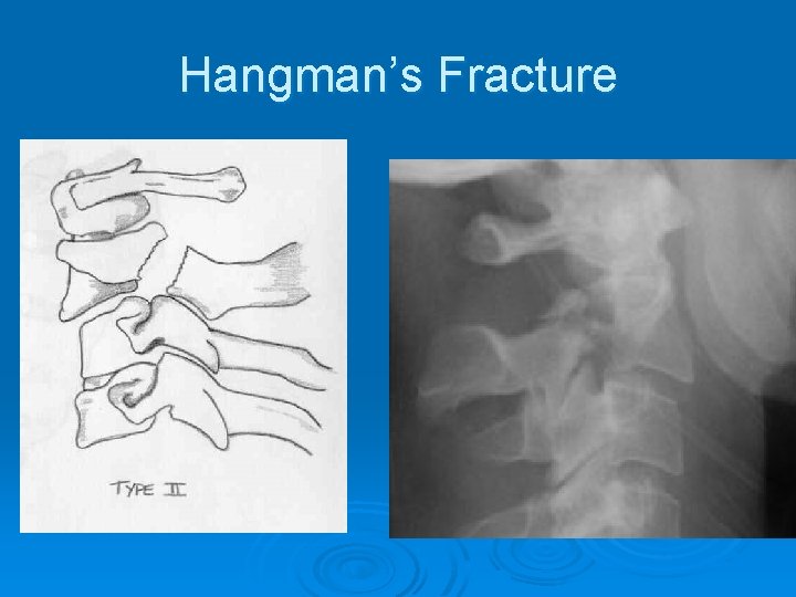 Hangman’s Fracture 