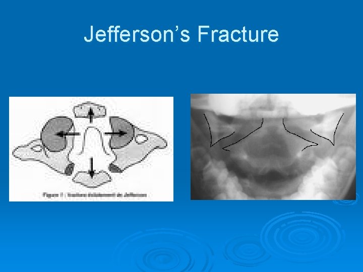 Jefferson’s Fracture 