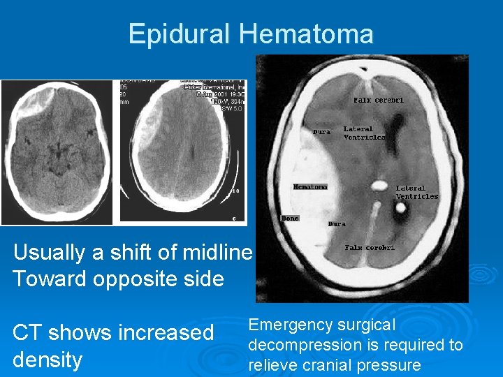 Epidural Hematoma Usually a shift of midline Toward opposite side CT shows increased density
