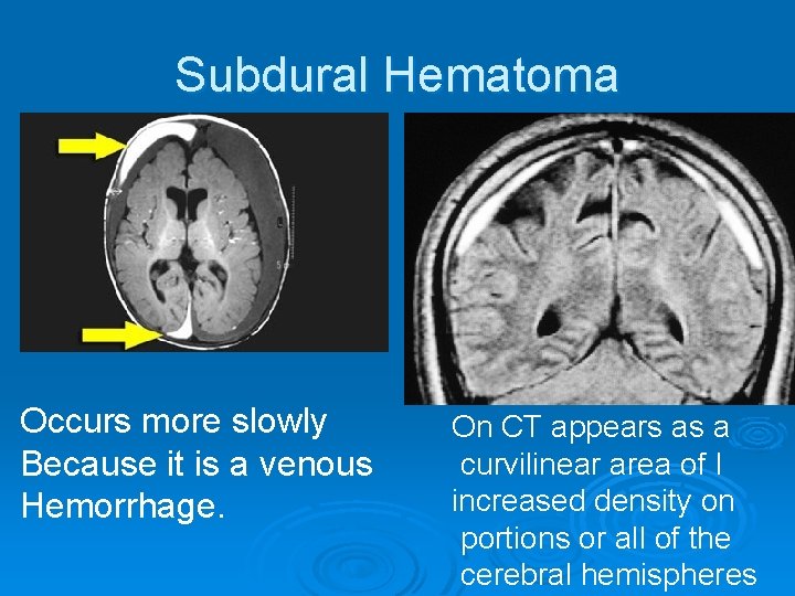 Subdural Hematoma Occurs more slowly Because it is a venous Hemorrhage. On CT appears