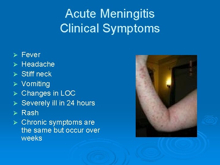 Acute Meningitis Clinical Symptoms Ø Ø Ø Ø Fever Headache Stiff neck Vomiting Changes