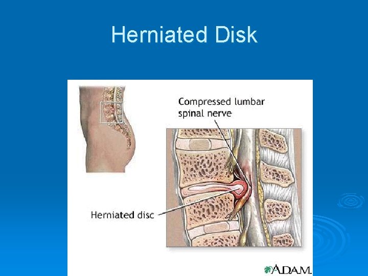 Herniated Disk 