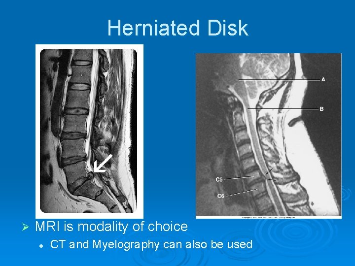 Herniated Disk Ø MRI is modality of choice l CT and Myelography can also