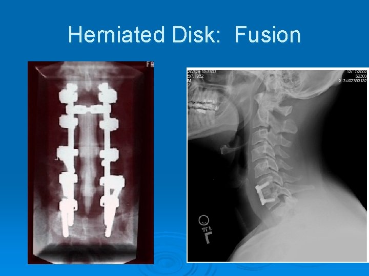 Herniated Disk: Fusion 