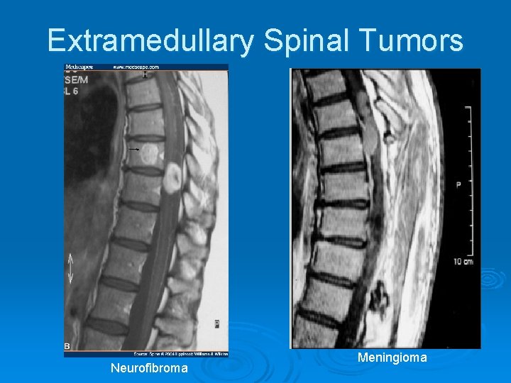 Extramedullary Spinal Tumors Neurofibroma Meningioma 