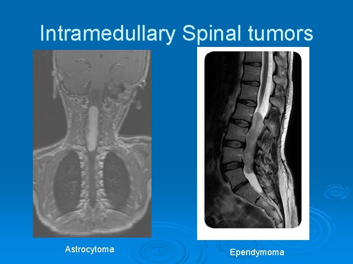 Intramedullary Spinal tumors Astrocytoma Ependymoma 
