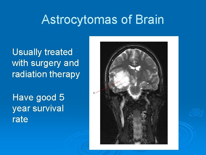 Astrocytomas of Brain Usually treated with surgery and radiation therapy Have good 5 year