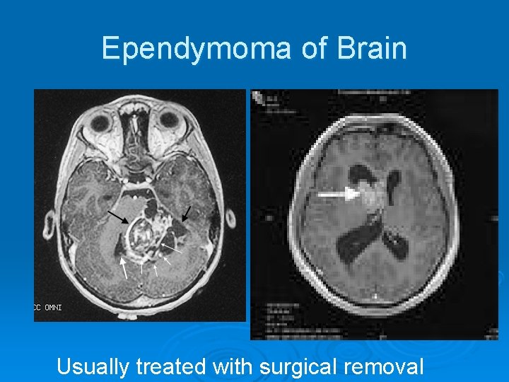 Ependymoma of Brain Usually treated with surgical removal 