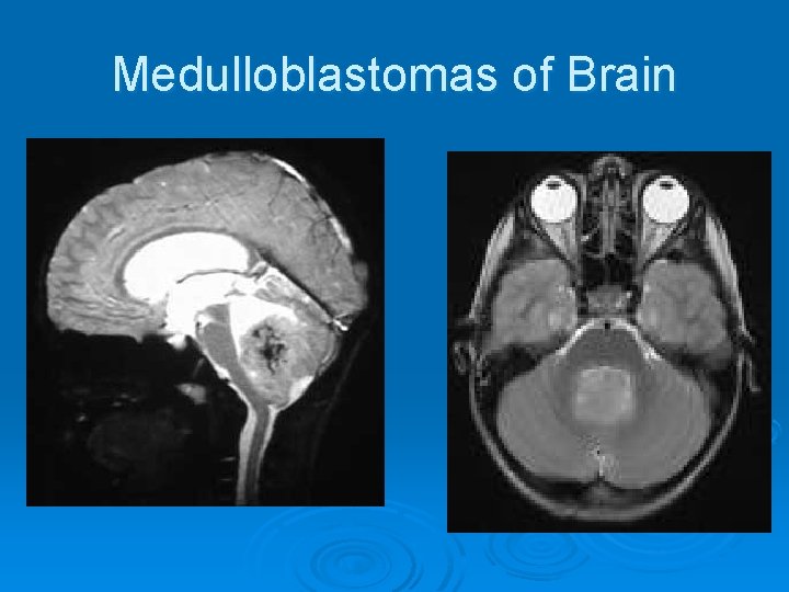 Medulloblastomas of Brain 
