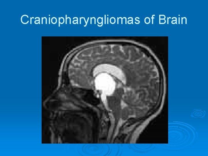 Craniopharyngliomas of Brain 