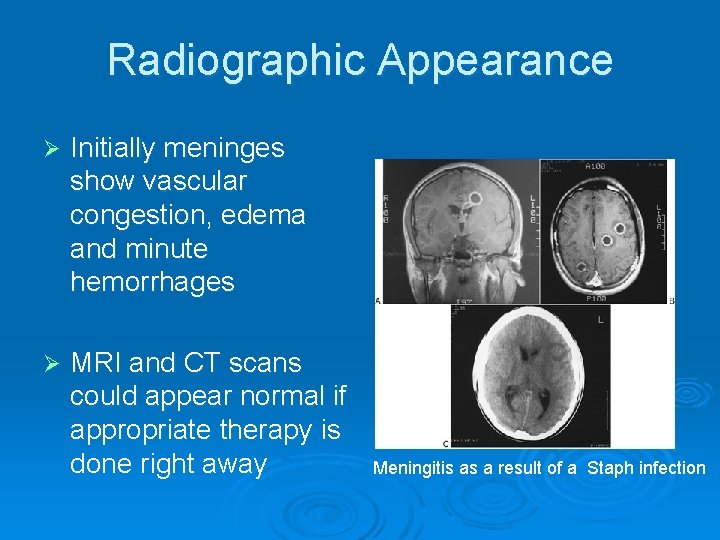 Radiographic Appearance Ø Initially meninges show vascular congestion, edema and minute hemorrhages Ø MRI