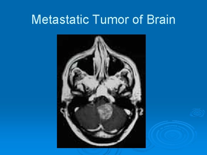 Metastatic Tumor of Brain 
