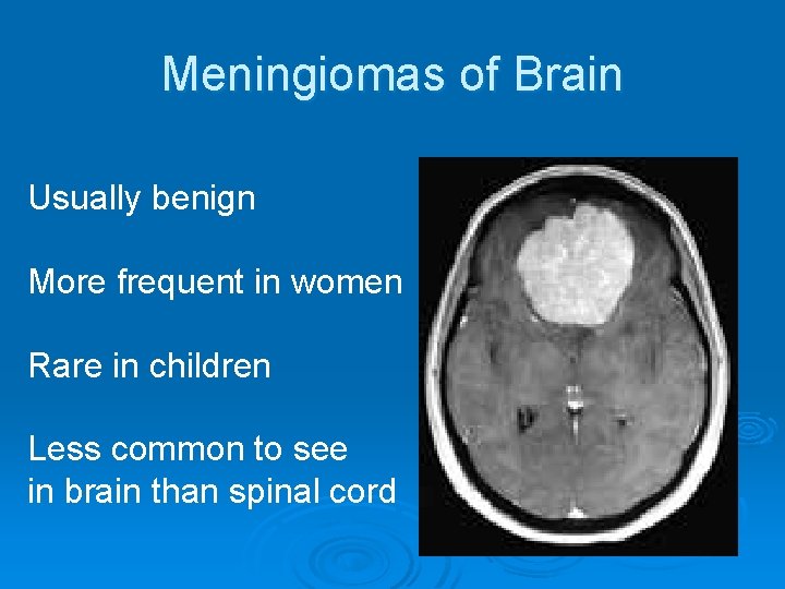 Meningiomas of Brain Usually benign More frequent in women Rare in children Less common