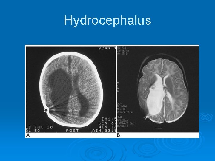 Hydrocephalus 