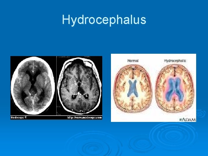 Hydrocephalus 