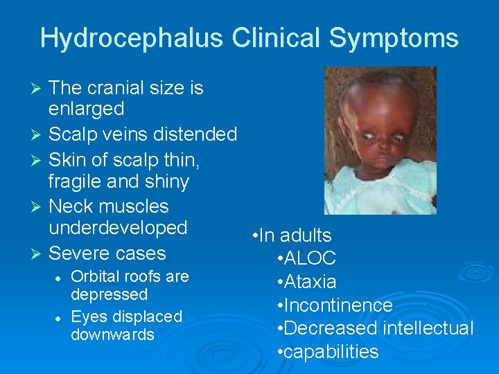 Hydrocephalus Clinical Symptoms The cranial size is enlarged Ø Scalp veins distended Ø Skin